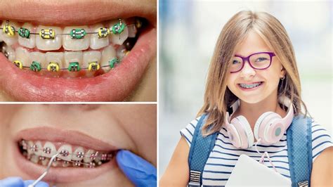 para que sirven los brackets metalicos|brackets de metal.